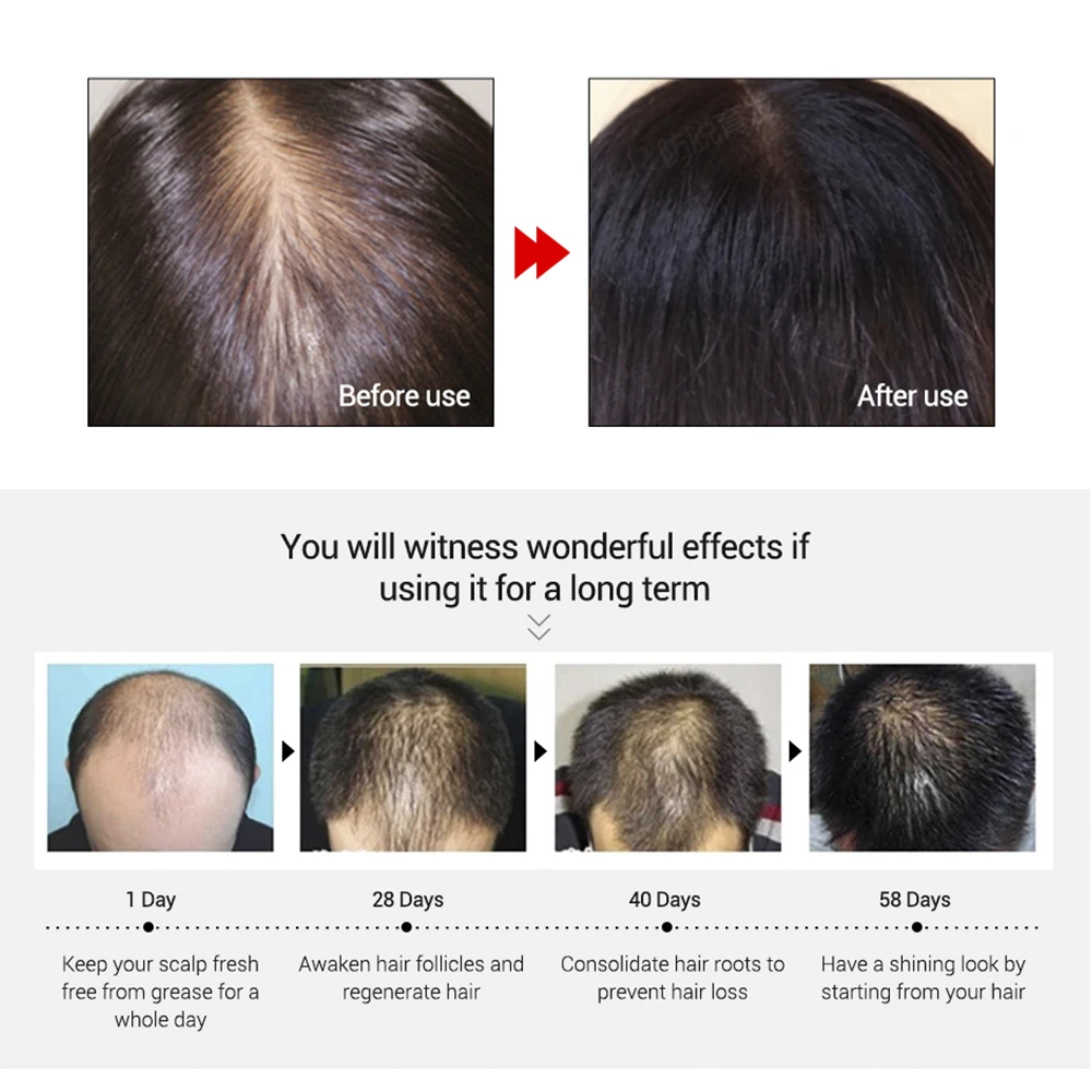 Эссенция для роста волос LANBENA уход за волосами мужчин и женщин эфирное масло