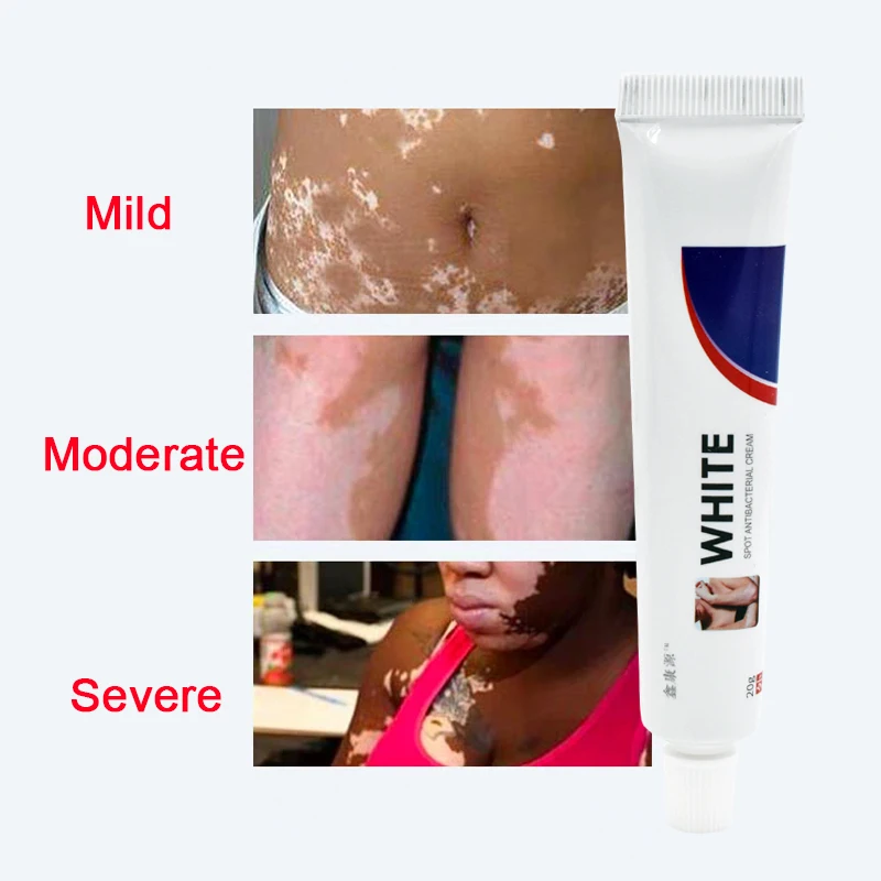 20 г Китайский медицинский крем с белыми пятнами пигмент меланин стимулирующий