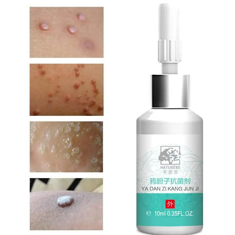 10 мл Антибактериальный раствор 0f для рук и ног тела Кукурузные коконы бородавки