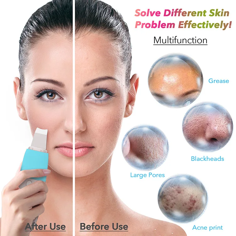 Beste Ultrasone Huid Scrubber Diepe Reiniging Gezicht Scrubber Vibrerende Gezichtsreiniging Huid Spatel Peeling Schoonheid Instrument Apparaat