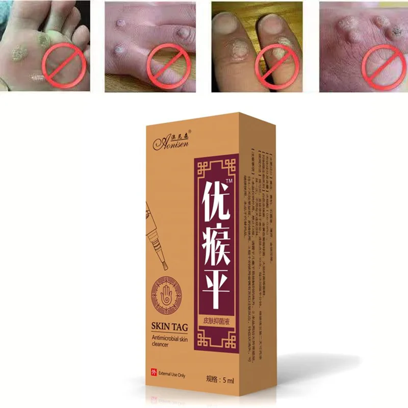 

5ml Genital Wart Treatment Papillomas Removal Of Warts Liquid From Skin Tags Removing Against Moles Remover Anti Verruca Remedy