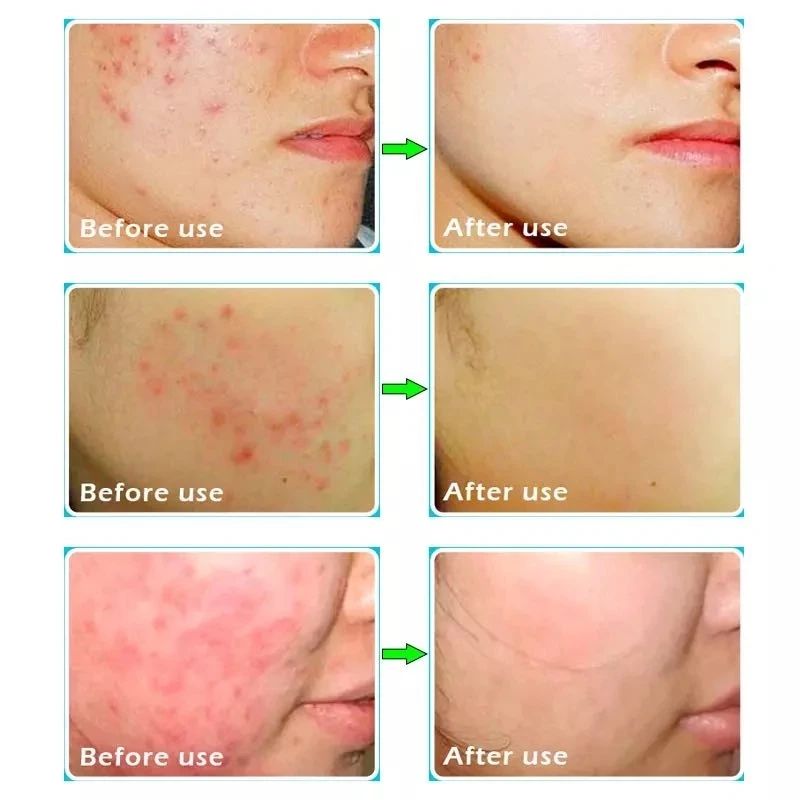 

Minch Hemp Serum+Cream Acne Treatment Face Whitening Cream Blackhead Repair Oil Control Shrink Pores Scar Collagen Cream