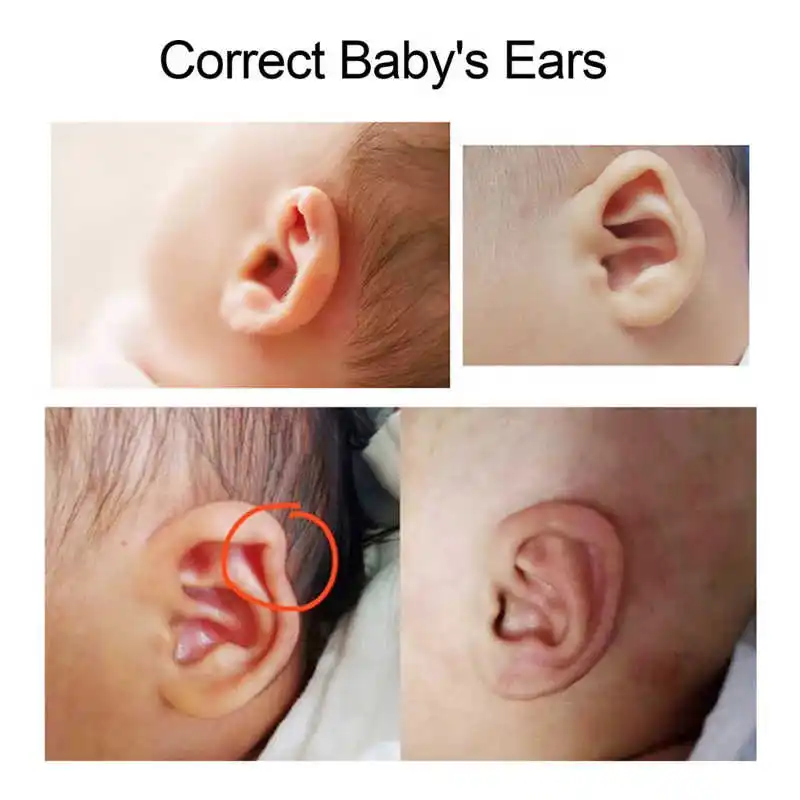 

4 x 50cm Silicone Newborn Baby Ear Aesthetic Correctors Kids Infant Protruding Ear Patch Stickers