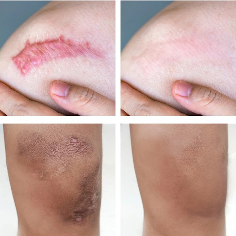 30 г крем удаляющий Шрамы Акне прямые от угревой сыпи гель для лица удаления угрей