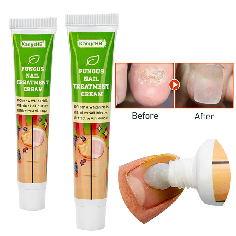 

1pcs Nail Fungus Treatment Cream Removal Feet Whitening Toe Care Plaster Nail Paronychia Onychomycosis Ointment