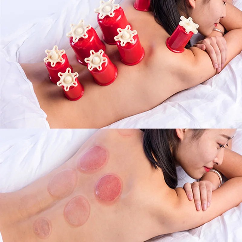 SHARE HO 4 размера ABS Вакуумные Банки ручной скрученный Cupping антицеллюлитные массажные банки присоска китайская терапия