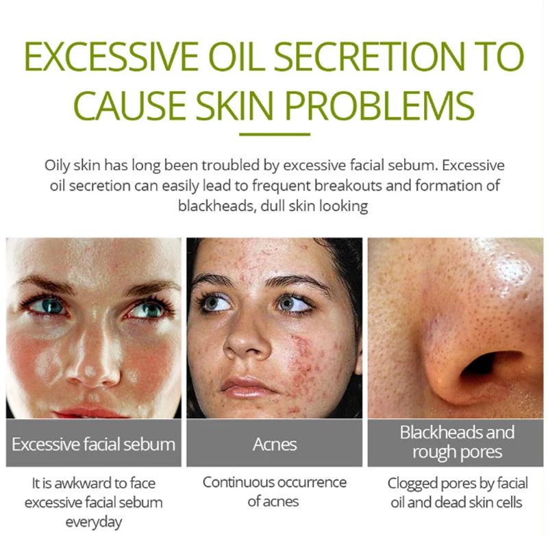 

Whitening Moisturizing Tea Tree Facial Cream Acne Scar Treatment Pore Shrink Oil Control Facial Skin Care CIN6 899