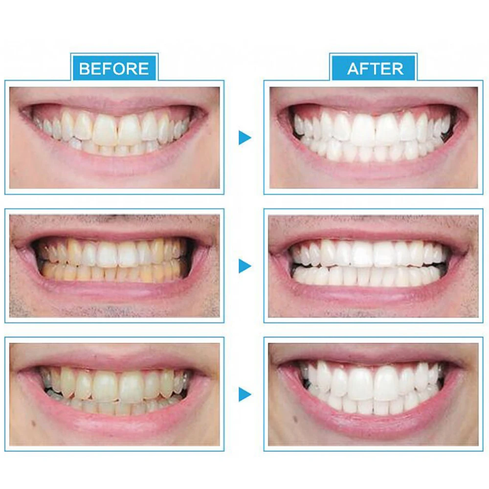 

Smart LED Teeth Whitening Device Built-in1 LEDs Light Dental Teeth Whitening Kit Teeth Bleaching Laser Lamp Whitening Instrument