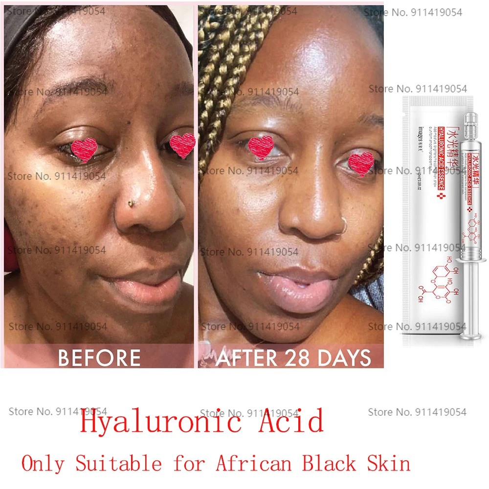 

Medical Hyaluronic Acid TO Remove Acne Mark and Stubborn Acne Only Suitable for African Black Skin