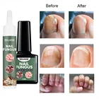 Средство для лечения грибков ногтей жидкость для удаления грибка ногтей питательное средство для лечения грибка ногтей восстановление ногтей грибковые ногти ремонт ногтей