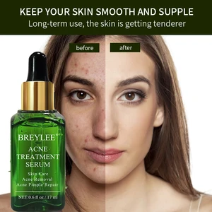 Уход за лицом Крем для удаления угревых рубцов Уход за кожей от следов от угрей Лечение рубцов Вытягивание рубцов Отбеливающие эфирные масла для лица для удаления угрей