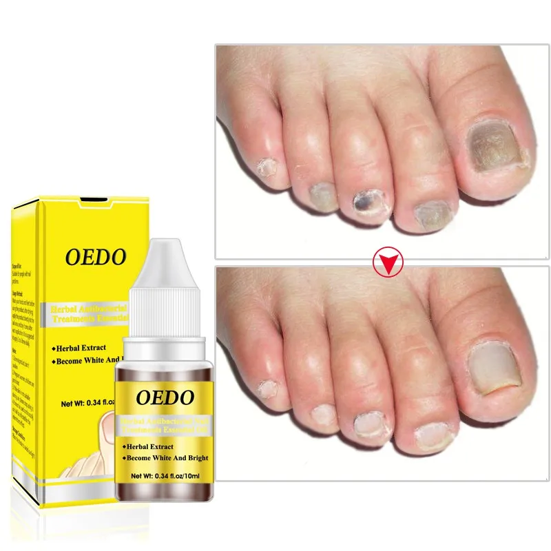 Травяные Антибактериальные Средства для ухода за ногтями экстракт эфирного