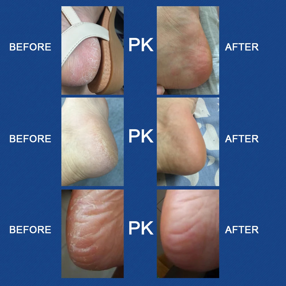 

Electric Foot Grinder Heel File Grinding Exfoliator Pedicure Machine Foot Care Tool Foot Grinding File Dead Skin Callous Remover