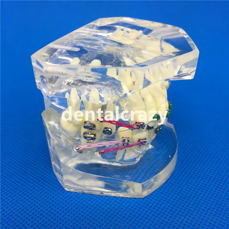 Стоматологическая модель зубов прозрачная ремонта патологического имплантата