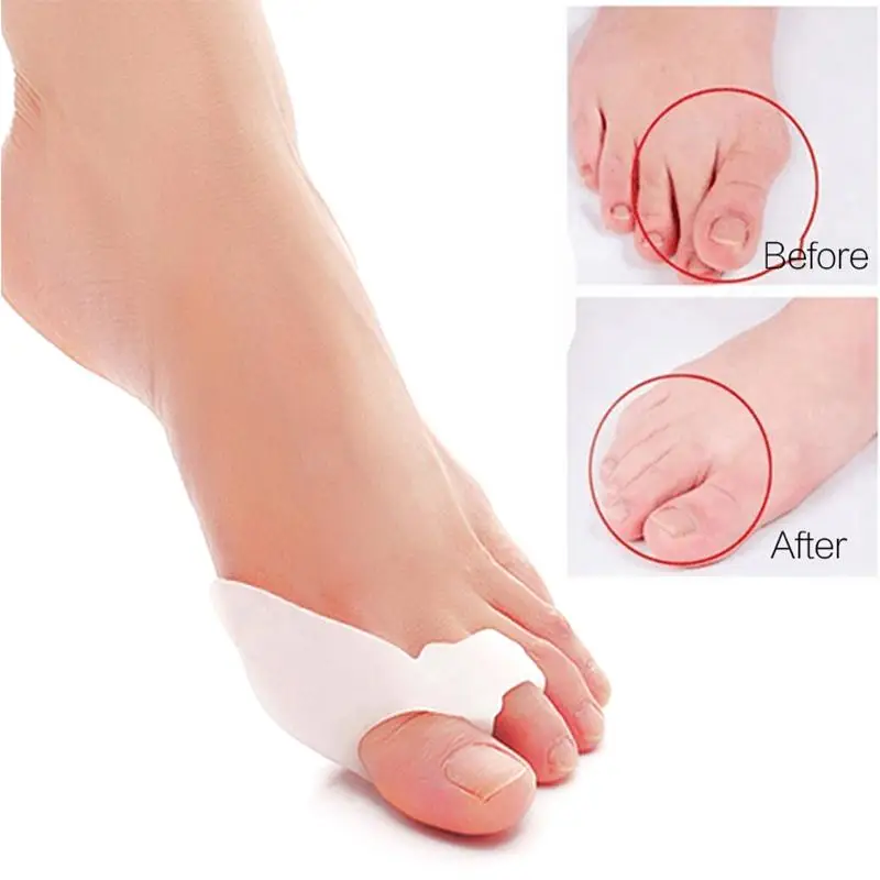 2 шт. вальгусная деформация корректор для соединения пальцев сепаратор ног