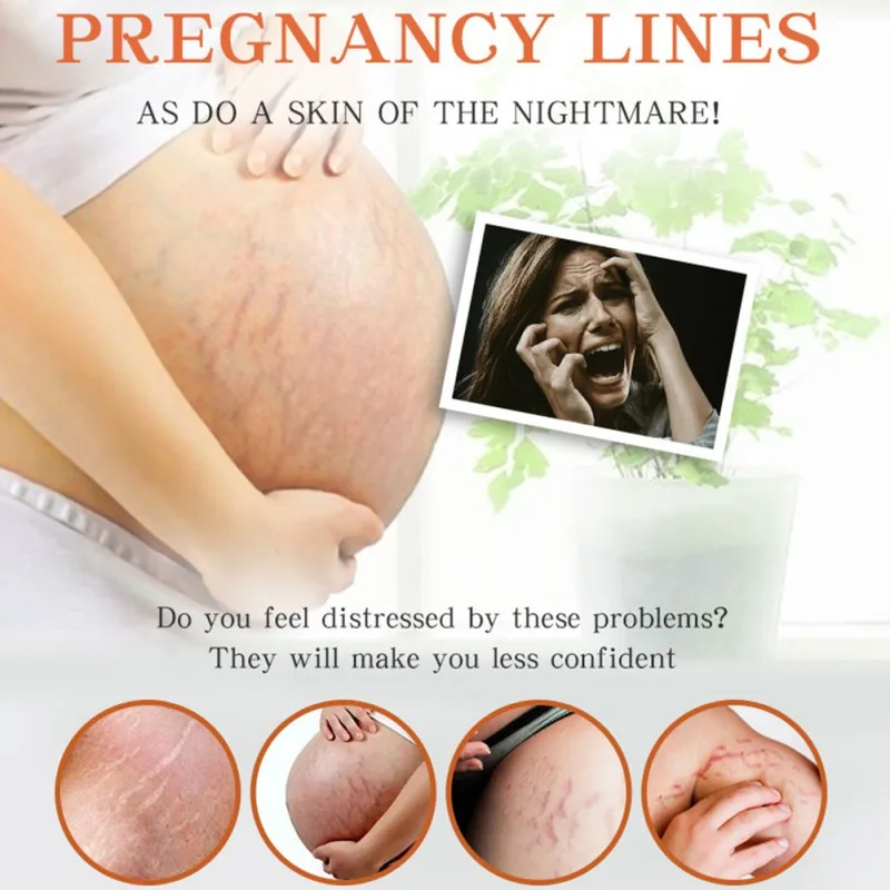 

45g Mild Scar Stretch Marks Removal Pregnant Cream Maternity Repair Skin Firming Anti-Aging Anti-Winkles Abdomen Leg Chest
