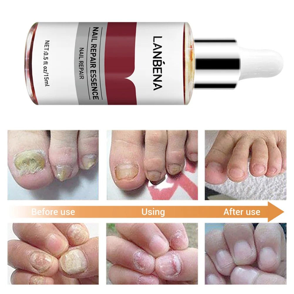 LANBENA Toenail Repair Essence для ногтей лечение грибка сыворотка онихомикоз трещины