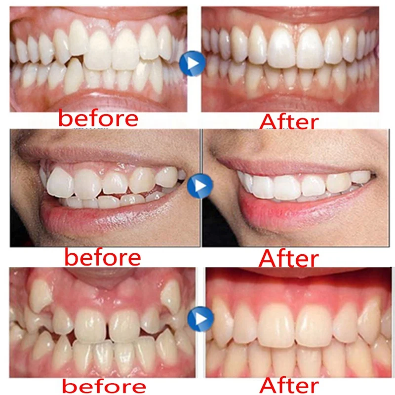 15 шт. ортодонтический бытовой Тренер коррекция зубов Buck брекеты ретейнер для