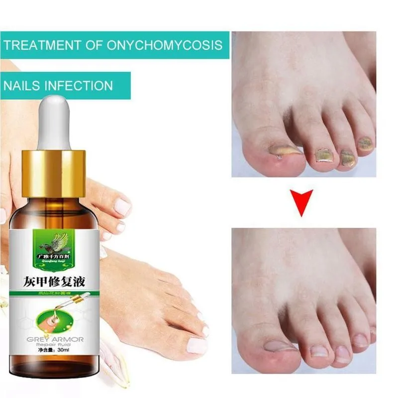 

30ML Hot Herbal Fungal Nail Treatment Nail Nail Fungus Removal Anti Infection Paronychia Onychomycosis Nail Care Essential Oil