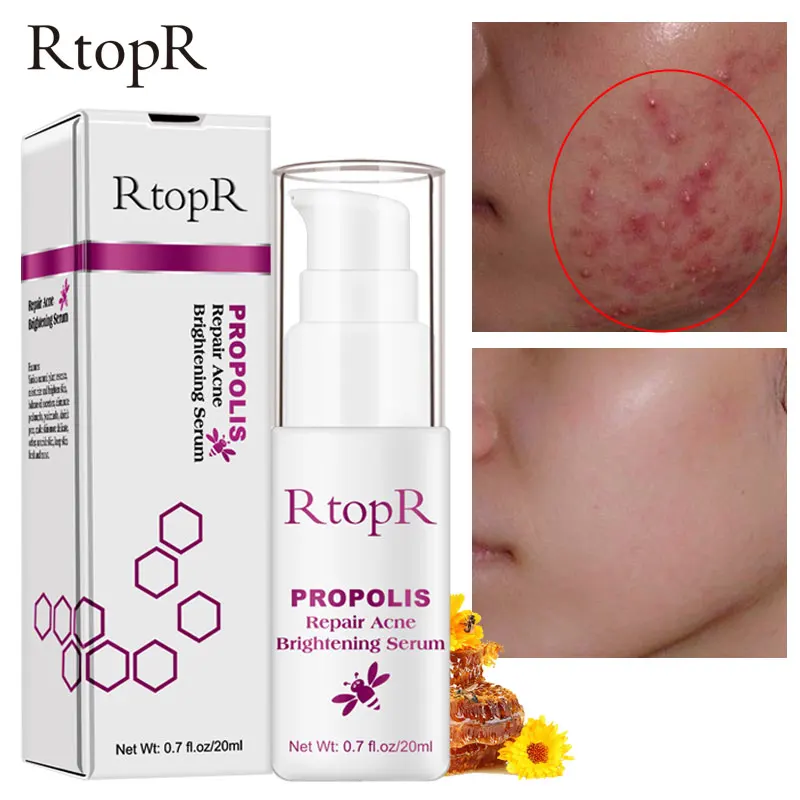

Herbal Against Anti Face Acne Pimple Remover Treatment Cream Patch Cleansing Moisturizing Korean Facial Skin Care Cream Cosmetic