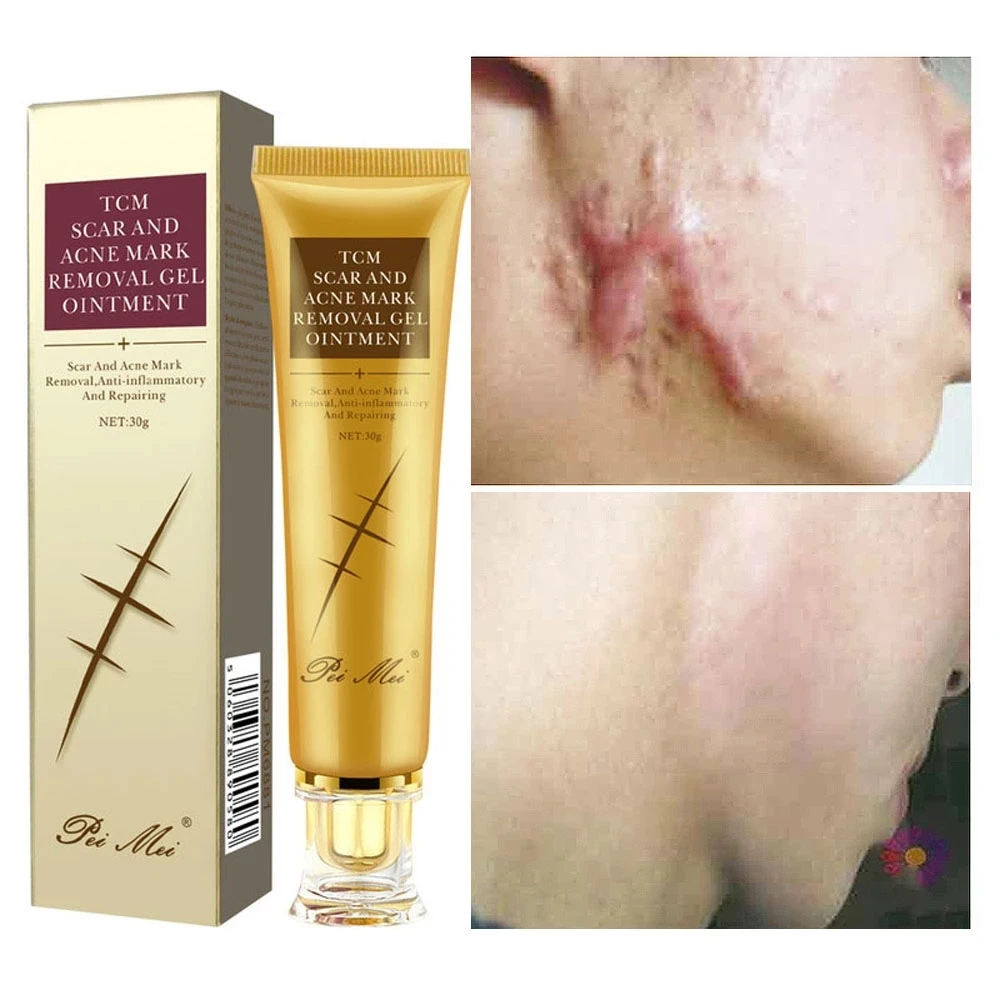 

2PCS Acne Scar Removal Cream Pimples Stretch Marks Face Gel Remove Acne Smoothing Whitening Moisturizing Body Skin Care 30g