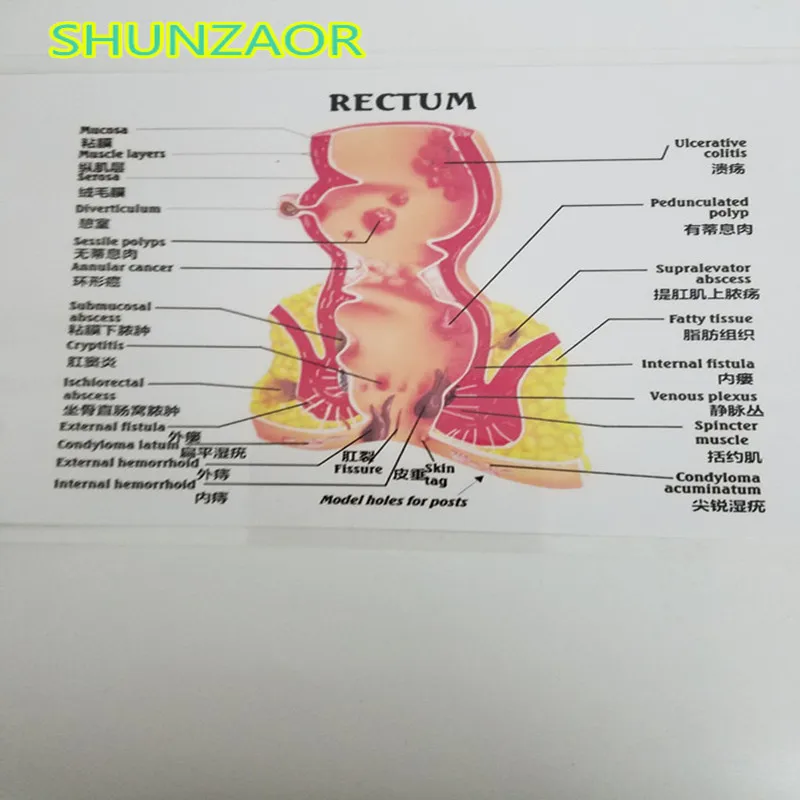 Патологии человека в прямой кишке анатомическая модель геморроя патологические