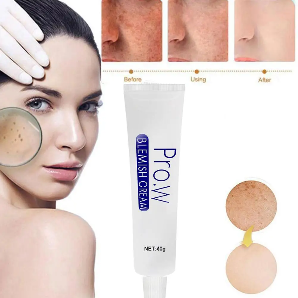 

Blemish Cream Freckles Acne Pimple Scar Dark Spots Skin Removal Whitening Brightening V9K1