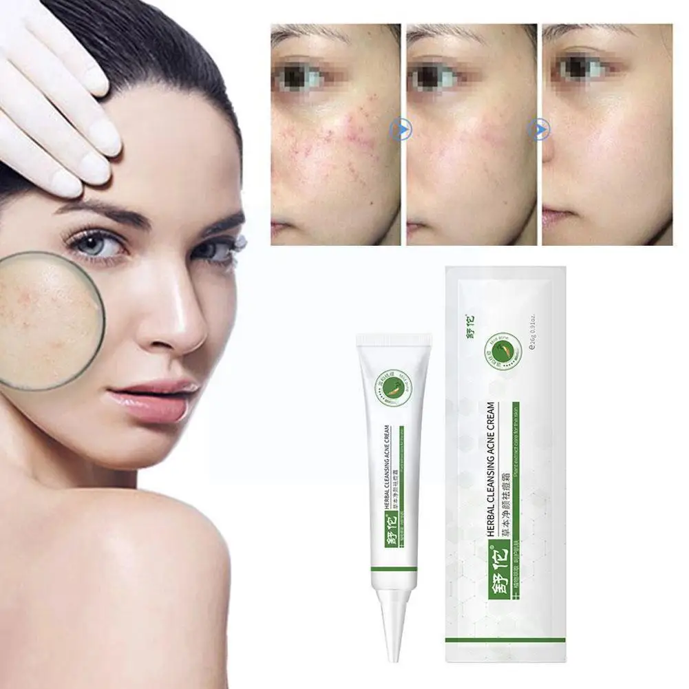 

26g Acne Cream Anti Moisturizing Whitening Moisturizing Skin Acne Essence Marks Peptide Fade Six Effectively Care Cream W8E4