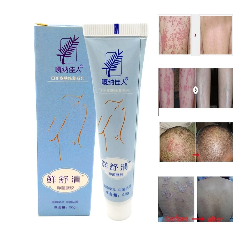 

Body Psoriasis Dermatitis And Eczema Pruritus Skin Problems China Herbal Bacteriostatic Gel PsoraCreams