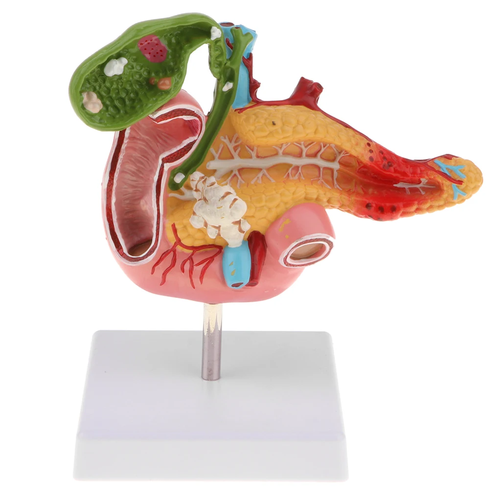 

1:1 человеческий желчный пузырь Duodenum, патологическая анатомическая модель