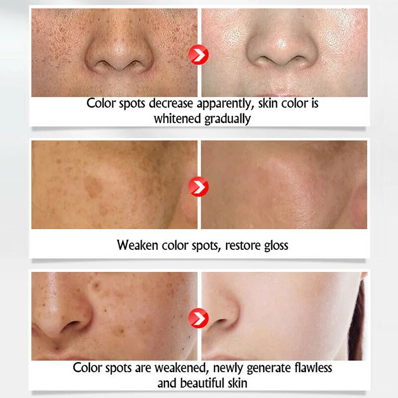 

Freckle Cream for Anti-wrinkle Face Stains Dark Spot Skin Pigmentation Skin Whitening Cream STTX889