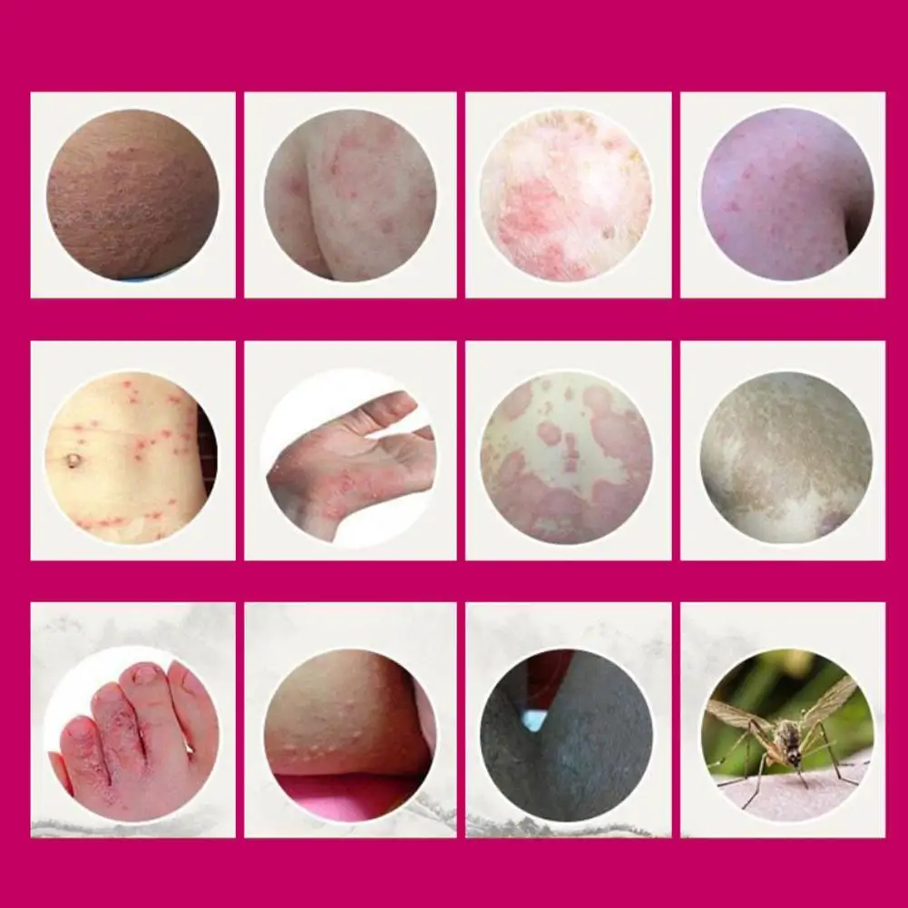 

Profesprofessional Cure Psoriasis Ointment Medicine Ingredient Security For All Kinds Problems psoriasis cream Skin Care cream