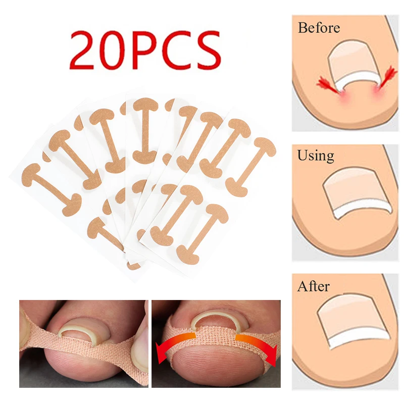 

Новый инструмент для педикюра, инструмент для вросших ногтей, корректор лечения, лечение паронихии, фиксатор, восстановление бурсита, педик...