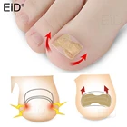 Корректор вросшего ногтя на ноге наклейка фиксатор лечения паронихии восстановление корректор для педикюра инструмент для ухода за ногтями на ногах клей бесплатный уход