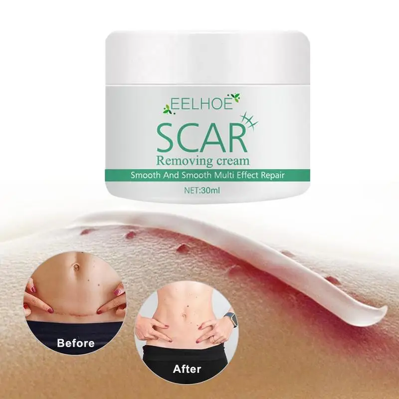 LANBENA Acne Scar Removal Cream Repair Acne Spots Acne Marks Stretch Whitening Skin Shrink Treatment Blackhead Care Pores A7S8