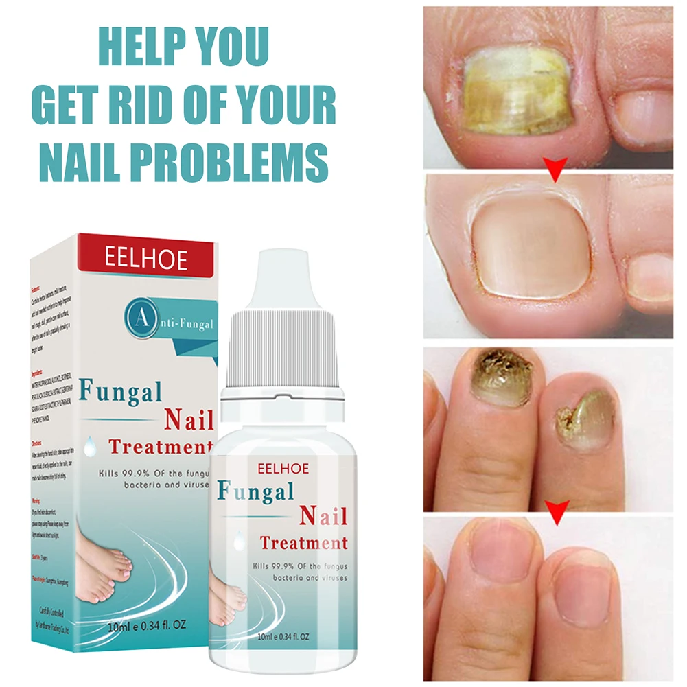 

10ml Fungal Nail Repair Essences Foot Toe Nail Fungus Treatments Nails Gel Anti Infections Removal Onychomycosis Nails Care