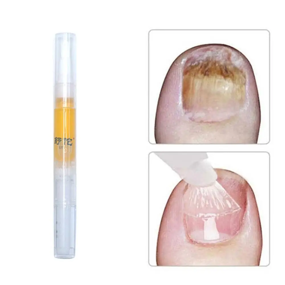 Противогрибковый набор для домашнего лечения ручка Ногтей онихомикоз пароникья