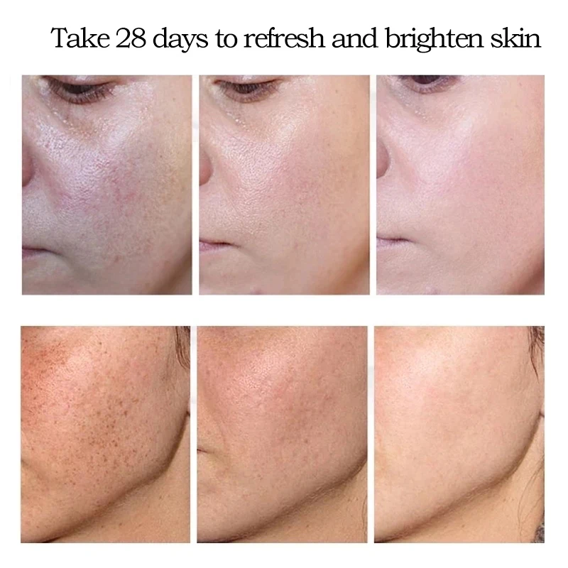 Whitening Freckle Cream Remove Melasma Dark Spots Melanin Remover Brighten Skin Anti-Aging Lightening |