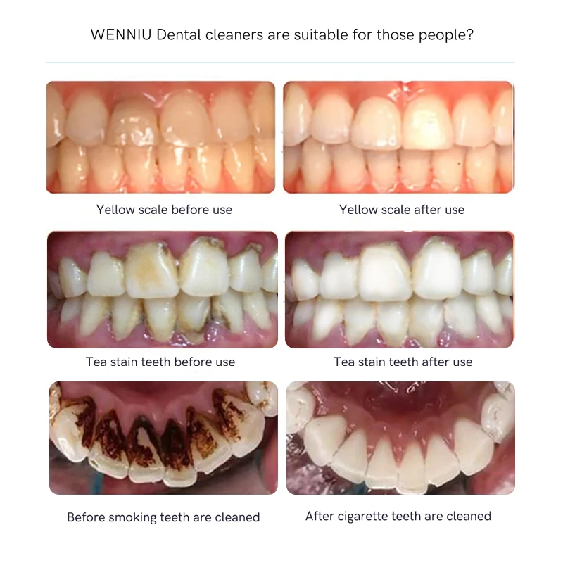 

Electric Tooth Polisher 4In1 Multifunction Dental Stain Plaque Remover Teeth Whitening Clean Odontologia Tooth Dirt Removal Tool