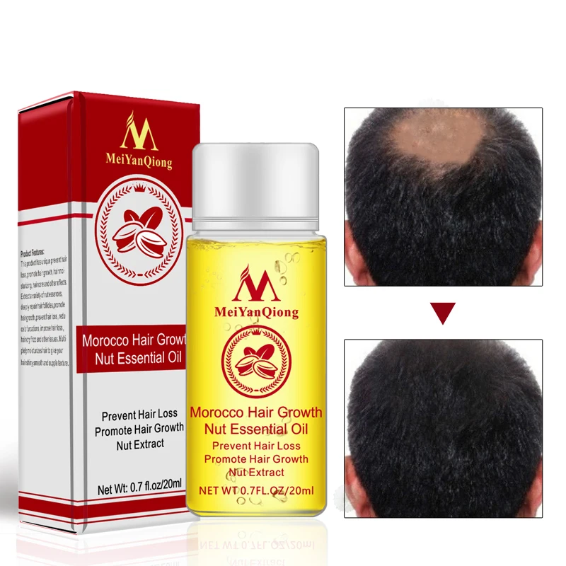 

MeiYanQiong Herbal Hair Growth Treatment Thick Hair Growth Essential Oil Anti-Hair Loss Promote Hair Growth For Women And Men