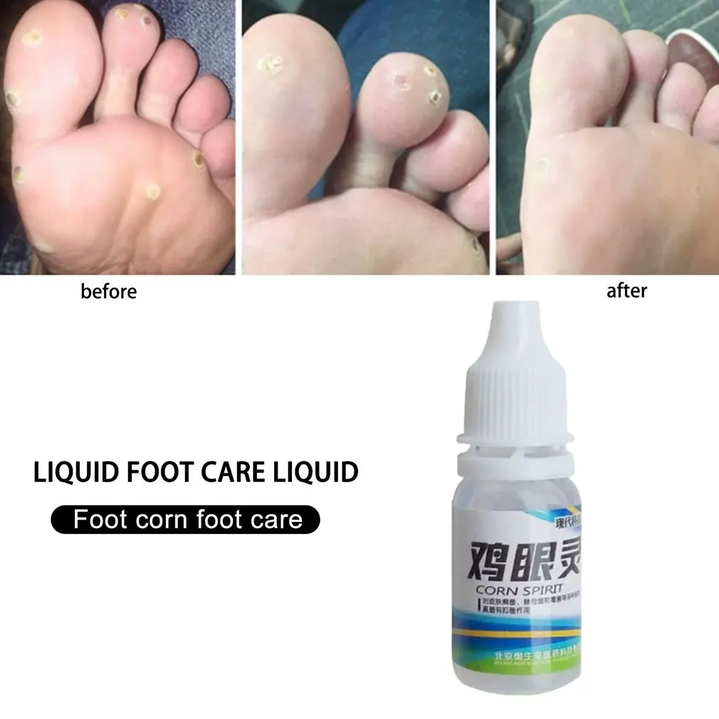 

10ml Powerful Foot Corn Remover Useful Foot Callus Remover Liquid Foot Corn Foot Care Liquid