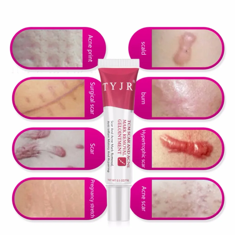 Крем для восстановления шрамов и ожогов кожи крем тела удаления омоложения