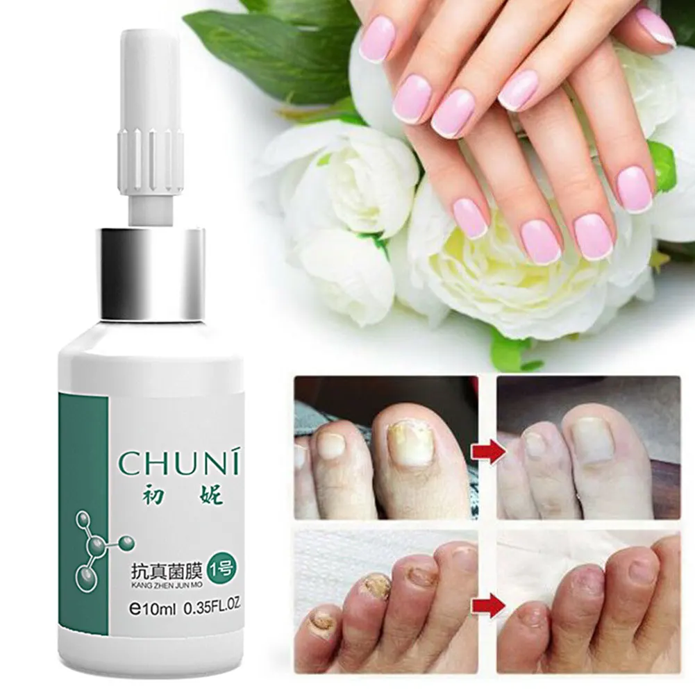 20 мл Ringworm Портативный Клей для ремонта ногтей ускоряет лечение роста Relustering