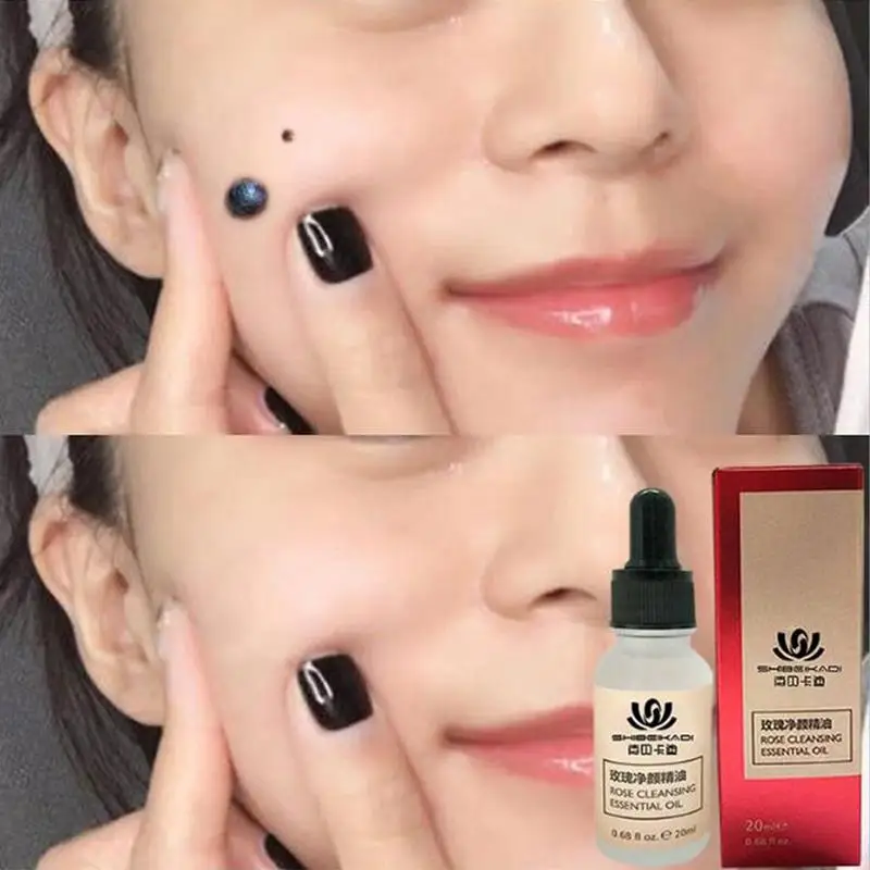 Mole & Skin Tag Removal Solution Painless Mole Skin Cream Tag Face Oil Spot Wart Freckle Removal Hot Dark Plaster Removal S F0N7 it s skin it s skin its skin