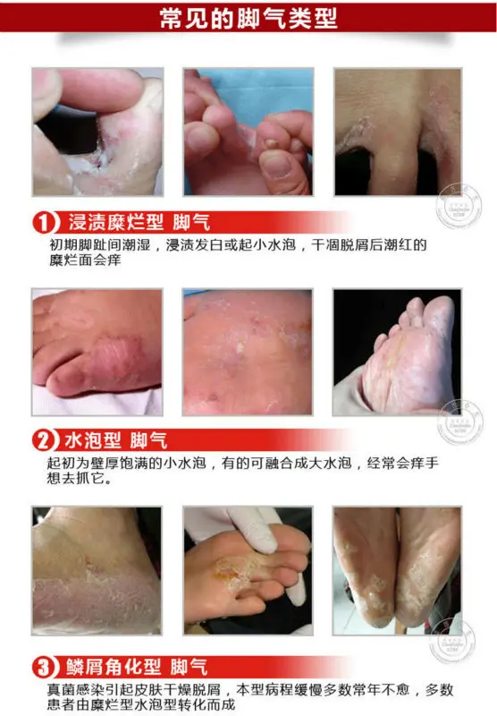 Традиционный китайский крем для ног забота о ногах спортсменов зуд волдыри