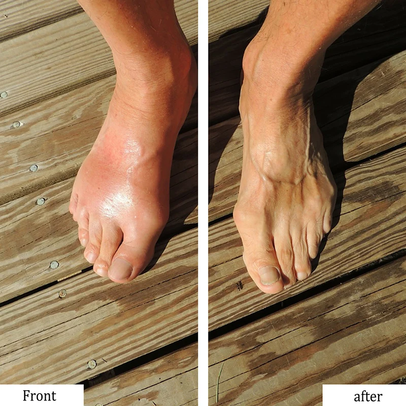 

2019 Anti-Stress Relief Foot Pad Anti-Inflammation Swelling Ginger Foot Care