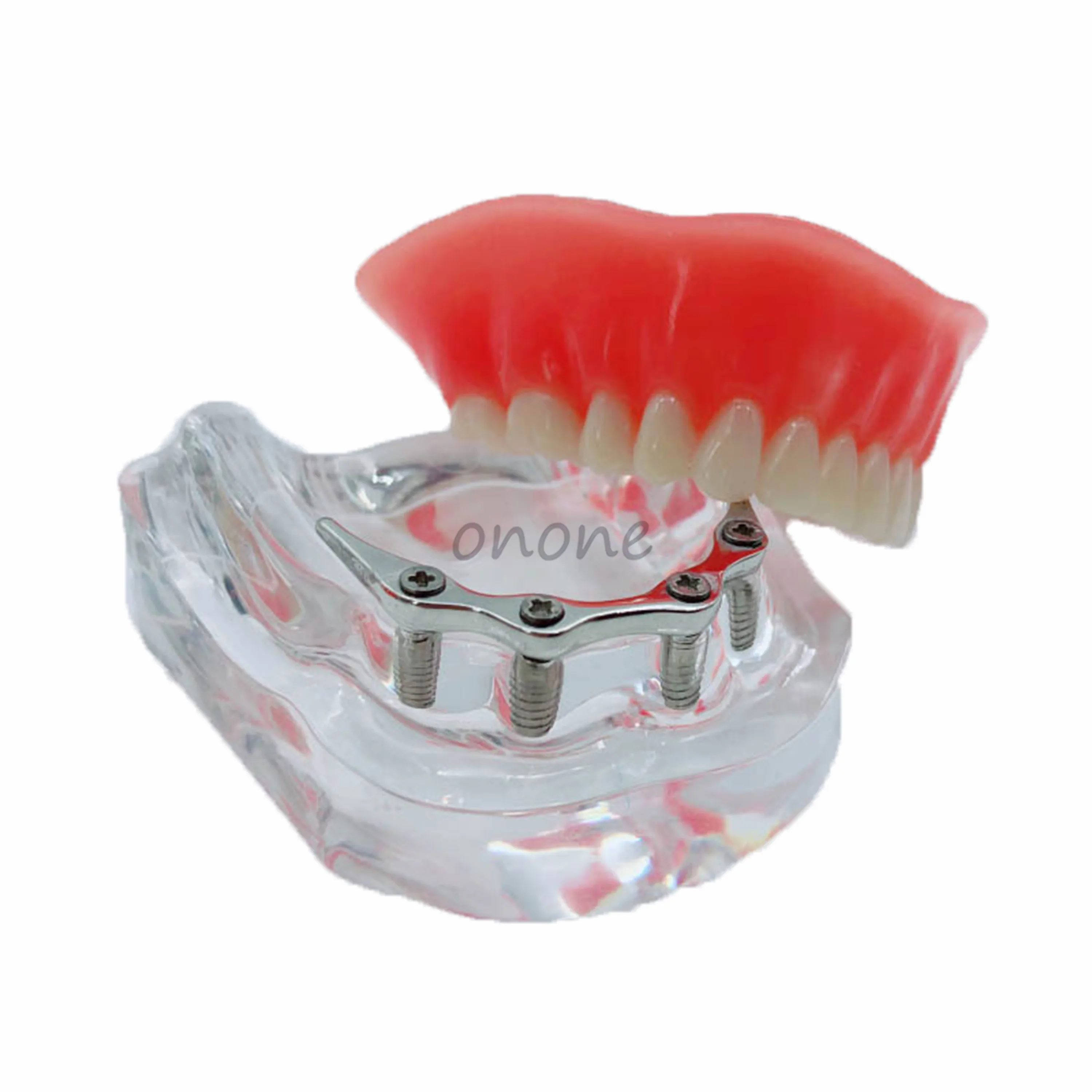 

Модель для восстановления зубного имплантата, 1 шт., с серебристым металлическим стержнем, 4 посадочных гвоздя, обучающая модель для студентов