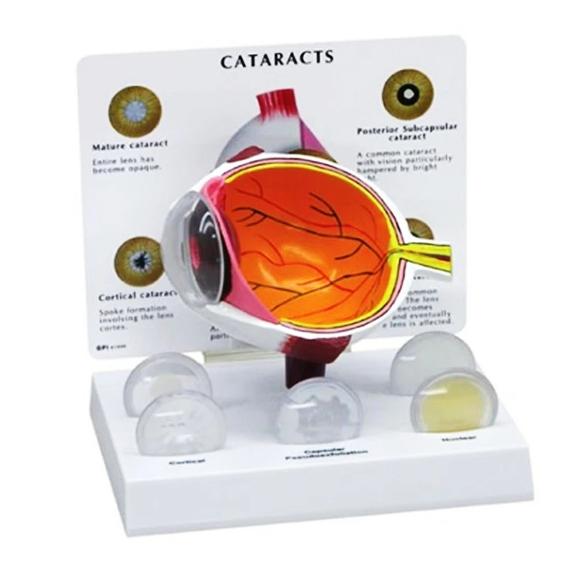 

4X Human Pvc Eye Cataract Anatomy Medical Teaching Model