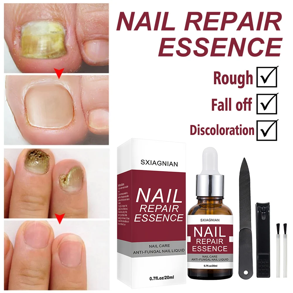 

Natural Herbal Nail Repair Essence Mild And No Irritation Fungus Treatment Cracked Rough Strengthen Damaged Fingernails Toenails
