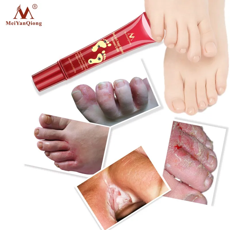 

Anti Fungal Infection Feet Repair Herbal Relieve Itching Treatment Foot Care Cream Foot Treatment 15g